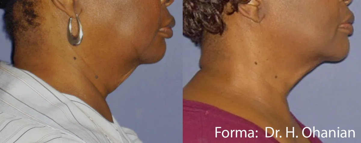 Före och efter, Forma. Dr H. Ohanian.