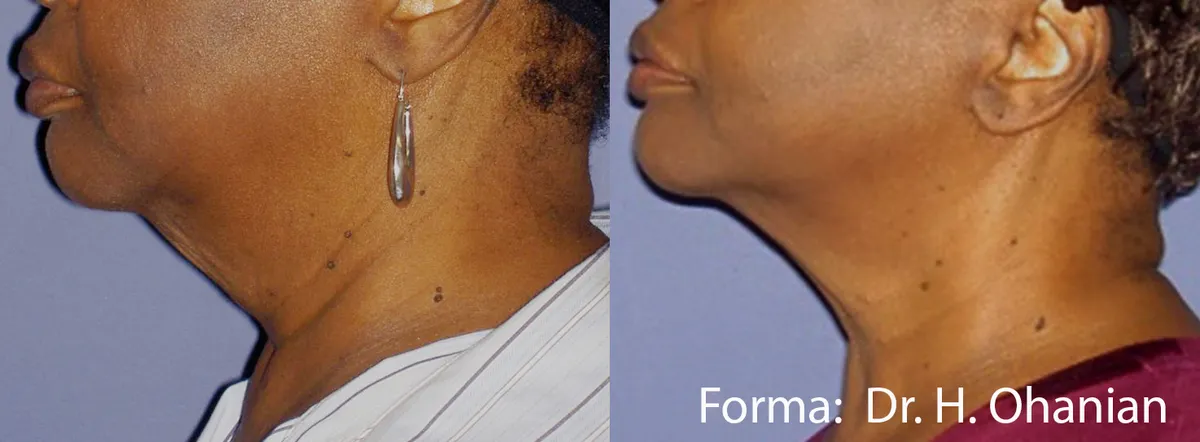Före och efter, Forma. Dr H. Ohanian.