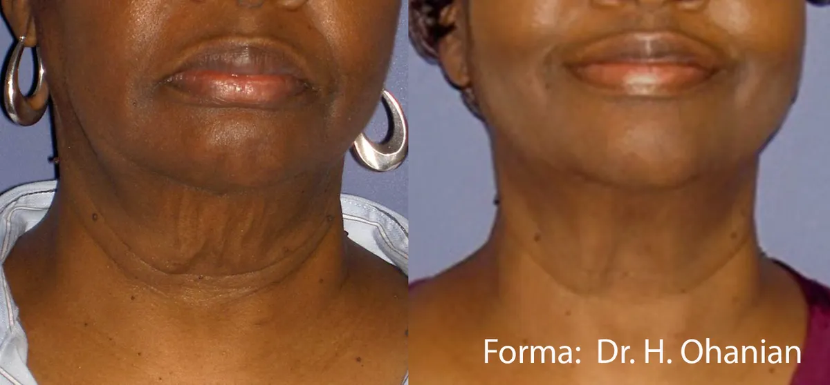Före och efter, Forma. Dr H. Ohanian.