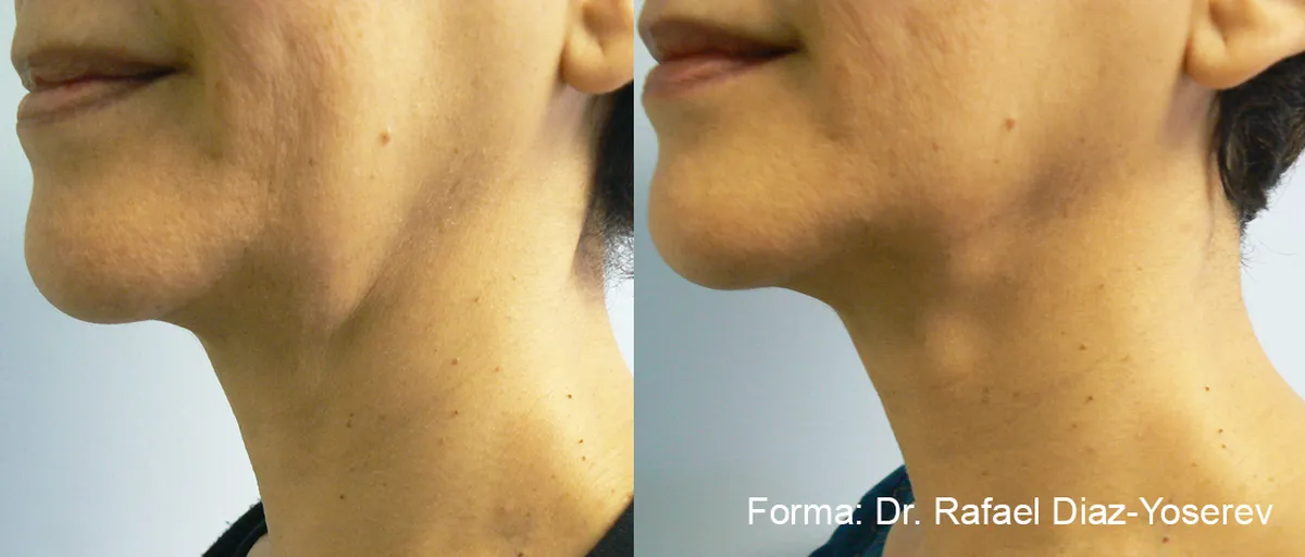Före och efter, Forma. Dr R. Diaz-Yoserev.