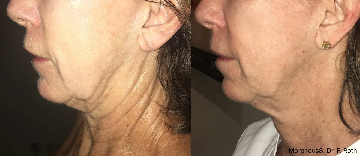 Före och efter, Morpheus8 Burst. Dr F. Roth.