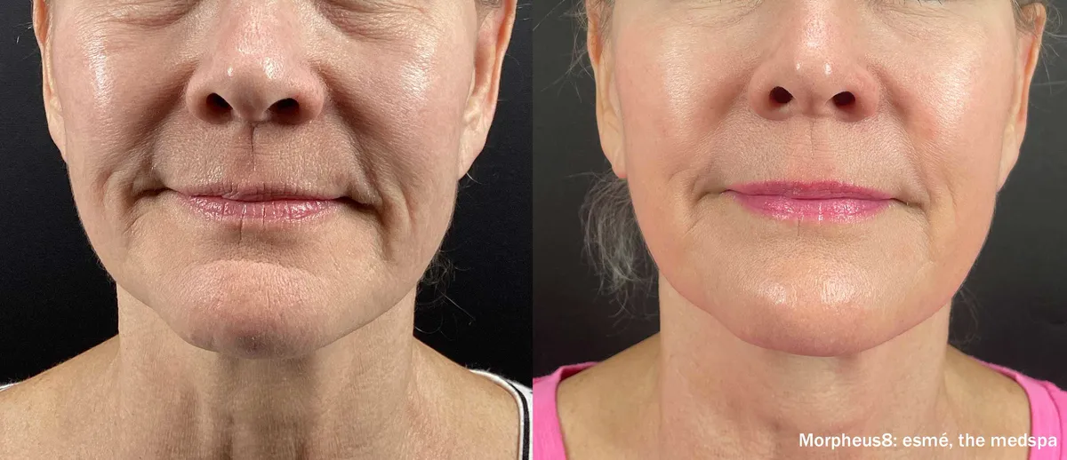 Före och efter, Morpheus8 Burst. Esme Medspa.
