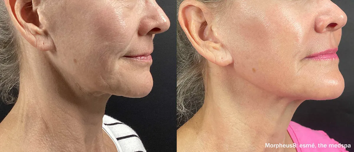 Före och efter, Morpheus8 Burst. Esme Medspa.