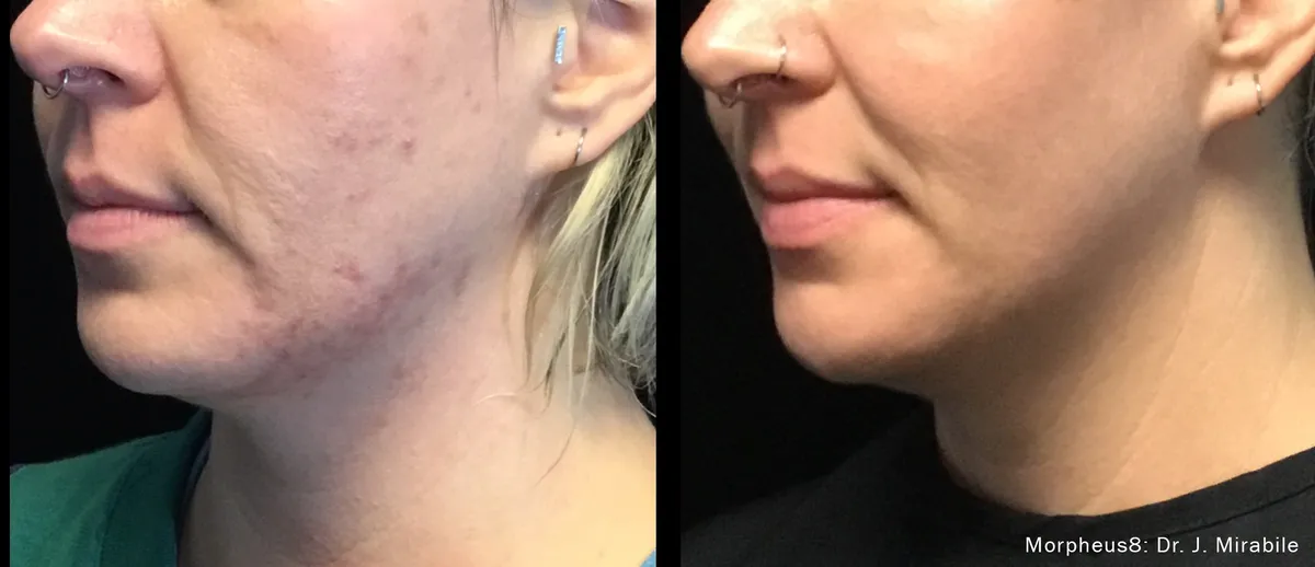 Före och efter, Morpheus8 Burst. Dr J. Mirabile.