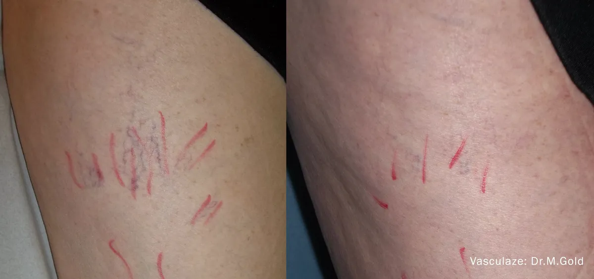 Före och efter, VasculazeMAX. Dr H. Goren.