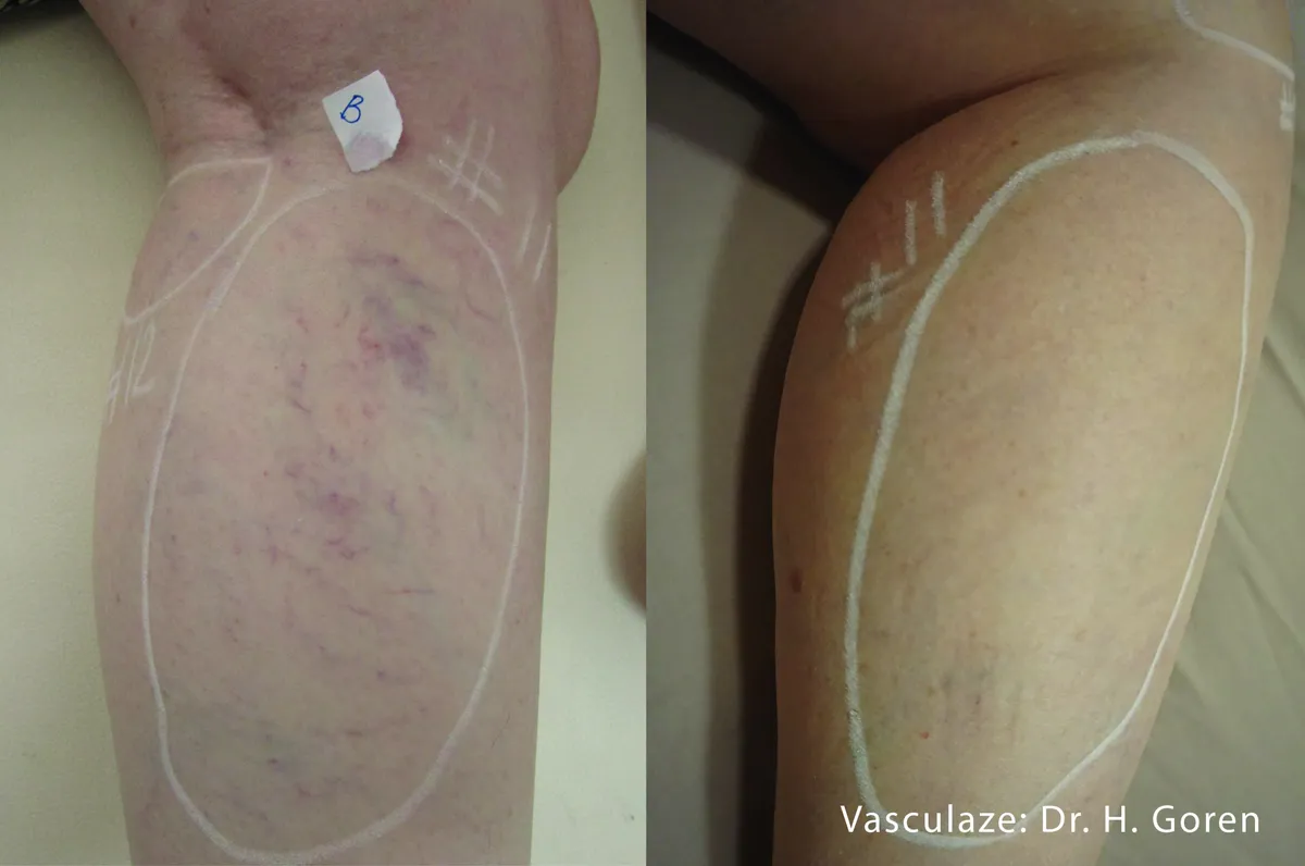 Före och efter, VasculazeMAX. Dr H. Goren.