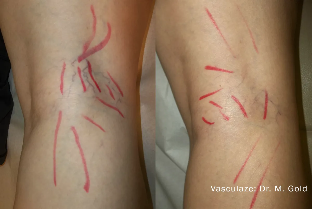 Före och efter, VasculazeMAX. Dr M. Gold.