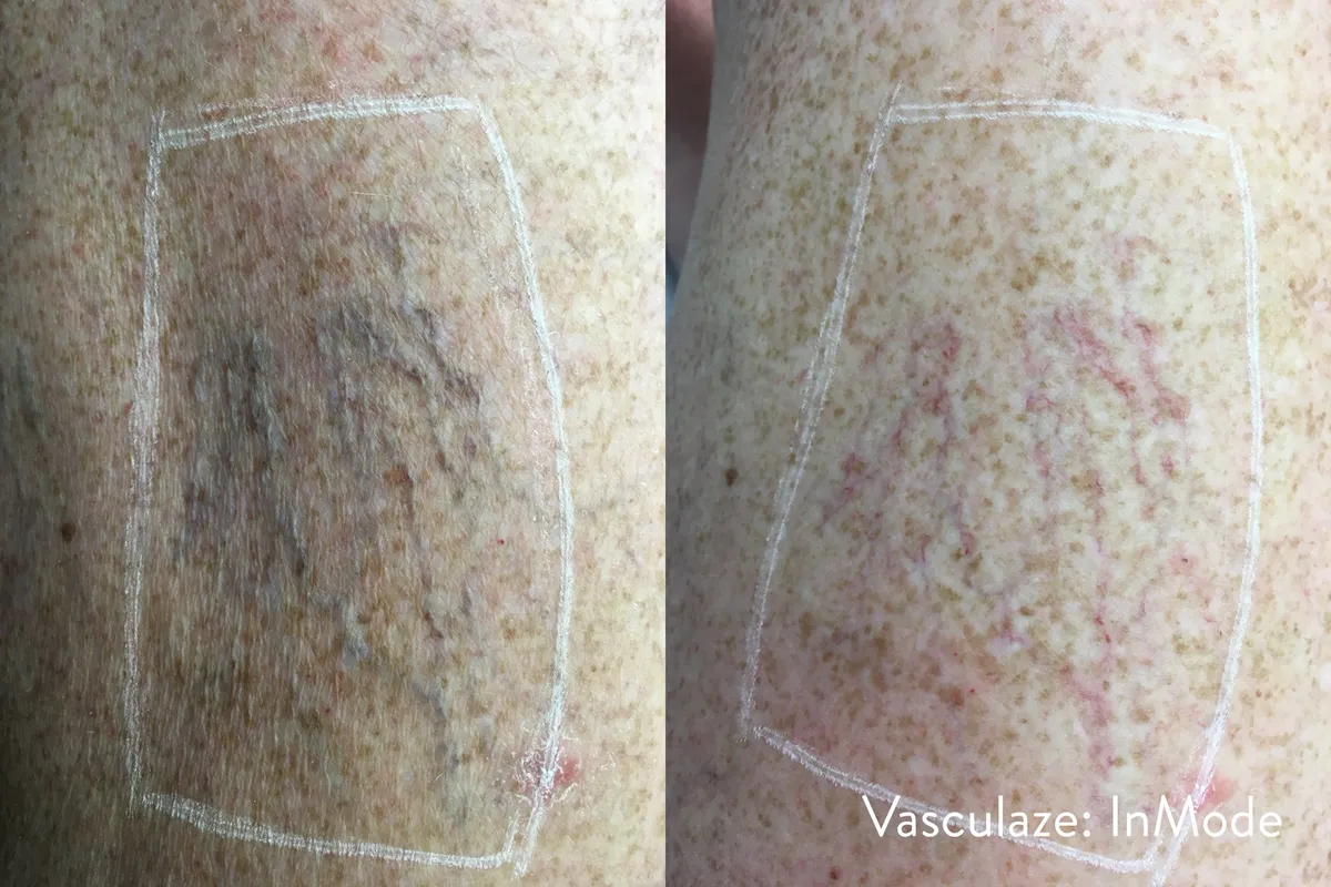 Före och efter, VasculazeMAX. InMode.