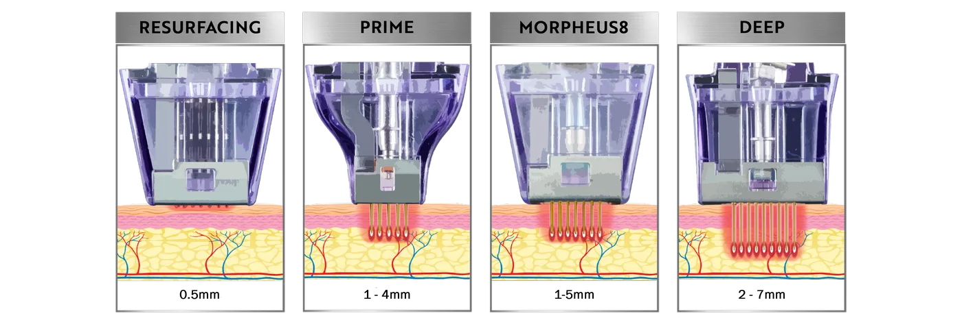 De fyra Morpheus8-spetsarna sida vid sida — Resurfacing, Prime, Morpheus8 och Deep — med respektive behandlingsdjup i huden.